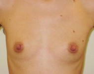 przed operacją plastyczną powiększania piersi
