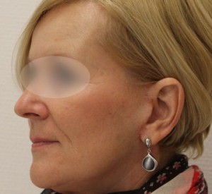 Profil twarzy kobiety po operacji liftingu twarzy