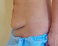 Przed operacją liftingu okolic brzucha