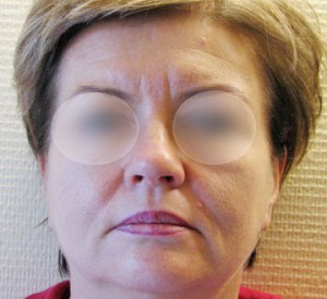 Kobieta przed operacją liftingu twarzy