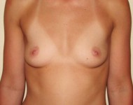 piersi przed operacją