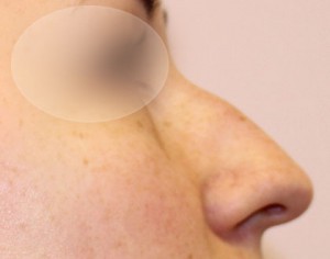 duży nos przed operacją