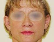 Kobieta po operacji liftingu twarzy