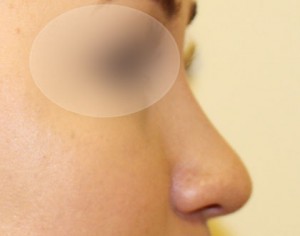 zgrabny nos po operacji korety nosa