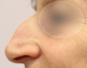 przed operacja korekty nosa