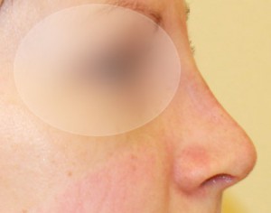 nos po operacji poprawy kształtu