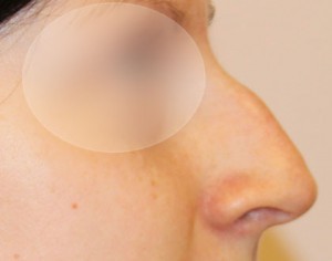 rginoplastyka poprawa kształtu nosa