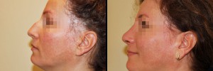 Zdjęcie twarzy z profilu - przed oraz po operacji nosa