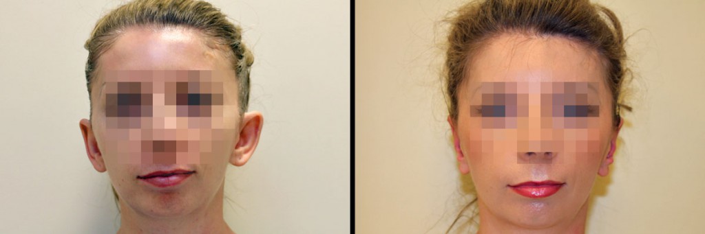 Uszy przed operacją i po - efekt zabiegu korekty uszu