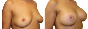 Operacja powiększenia piersi w klinice Dr Olender - przed i po.