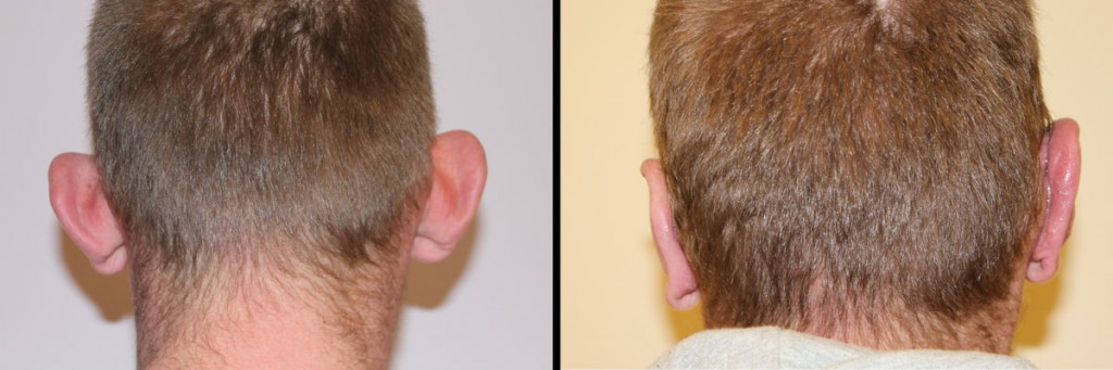Mężczyzna przed i po operacji uszu w Dr Olender
