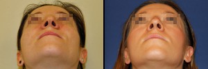 Zdjęcie nosa z dołu - przed operacją i po korekcie nosa