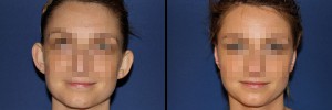 Kobieta przed i po zabiegu korekty uszu