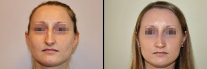 Twarz kobiety przed operacją i po operacji nosa
