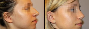 Nos przed operacja oraz po zabiegu w klinice Dr Olender