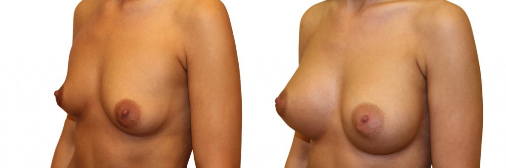 Efekty przed i po operacji piersi