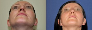 Przed oraz po korekcie nosa