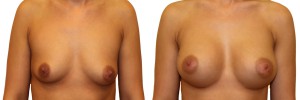 Przed i po operacji powiększenia piersi w klinice Dr Olender
