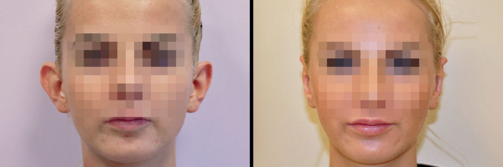 Porównanie - przed i po korekcie odstających uszu