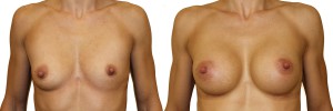 Powiększenie piersi - zdjęcia przed i po operacji