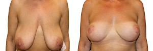 Operacja piersi w klinice Dr Olender - przed i po
