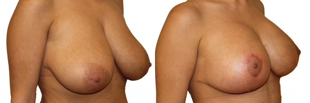 Plastyka piersi - piersi przed oraz po operacji