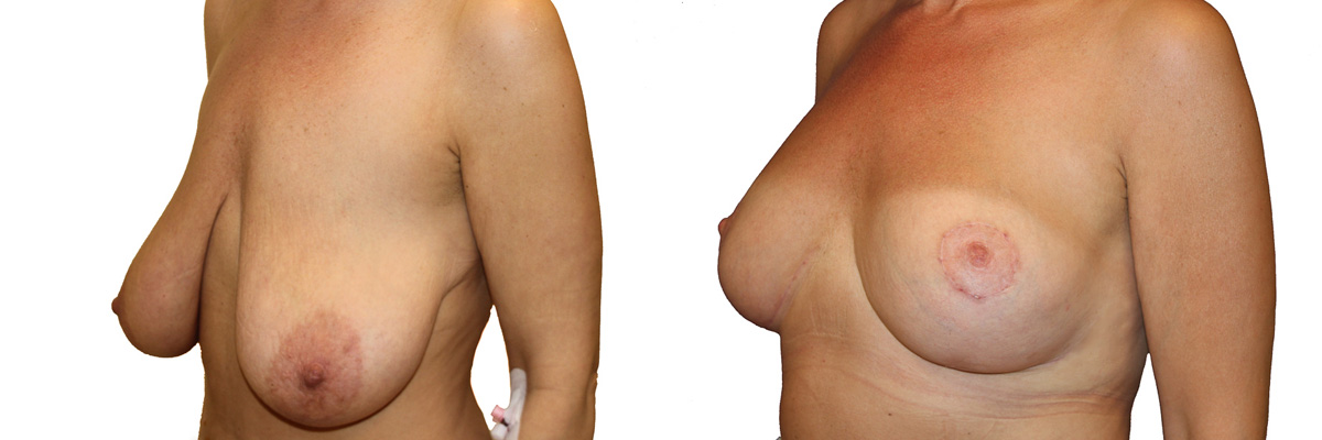 Operacja plastyki piersi z implantami