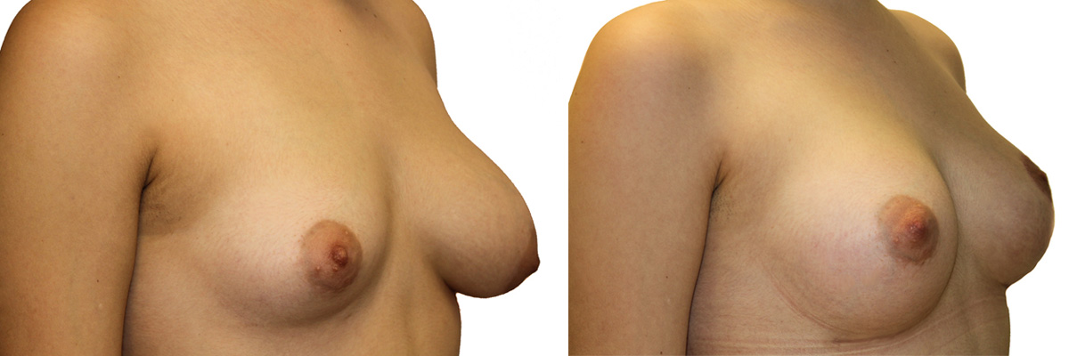 Podniesienie piersi przed i po operacji