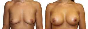 Przed i po operacji piersi