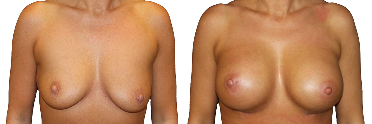 Przed i po operacji powiększenia piersi