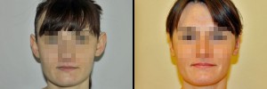 Korekta uszu - przed i po operacji