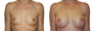 Przed i po operacją piersi - powiększaniem