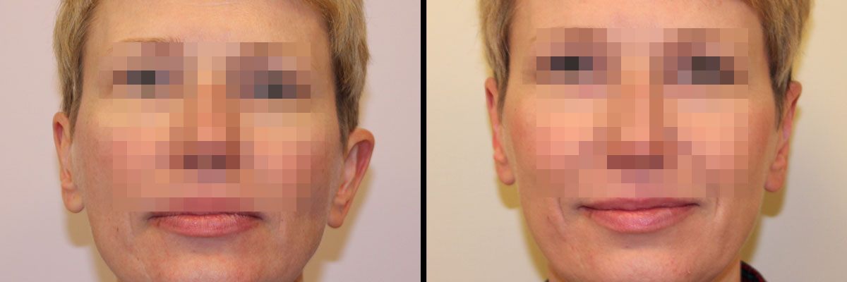 Przed i po operacji uszu w klinice Dr Olender