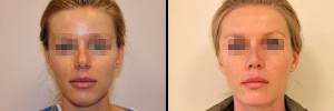 Zdjęcie przed operacją i efekt zabiegu korekcji nosa