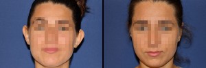 Przed i po operacji uszu