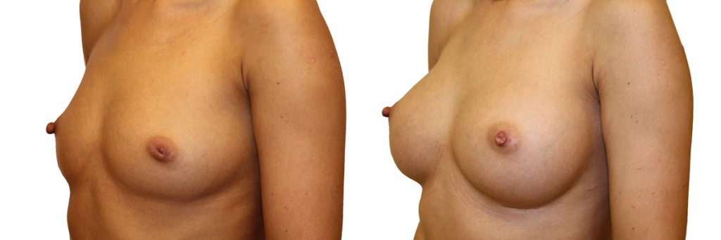 Piersi przed i po zabiegu - operacji powiększenia piersi.