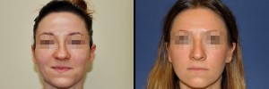 Kobieta - zdjęcie przed i po korekcji nosa