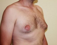 Powiekszone piersi u meżczyzny przed ginekomastą