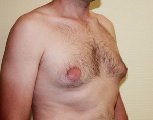 Powiekszone piersi u meżczyzny przed ginekomastą
