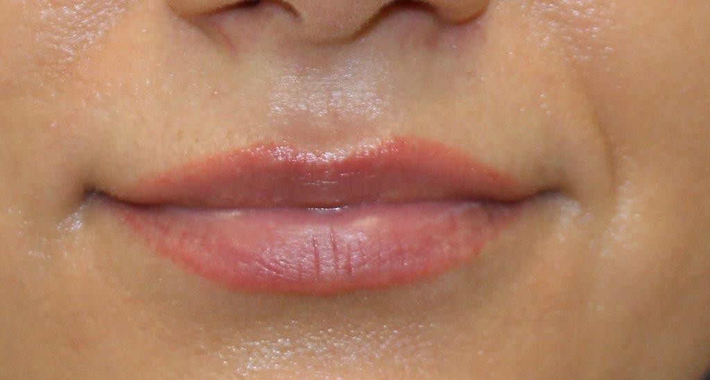 operacja plastyczna ust